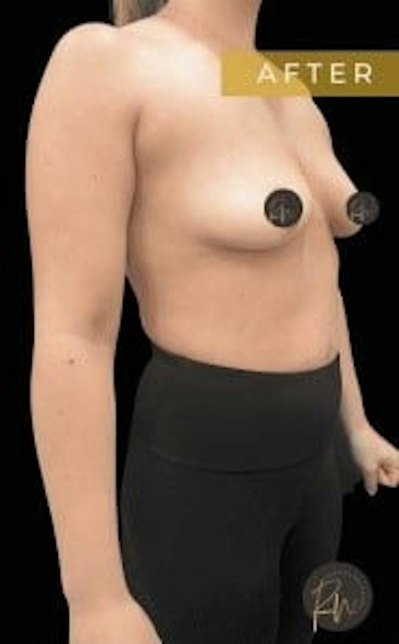 Breast Implant Removal Before & After Gallery - Patient 297066 - Image 6