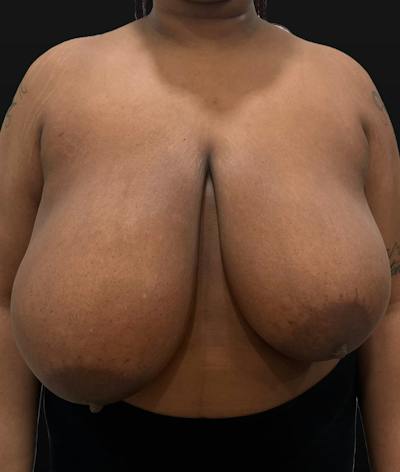 Breast Reduction Before & After Gallery - Patient 116976 - Image 1