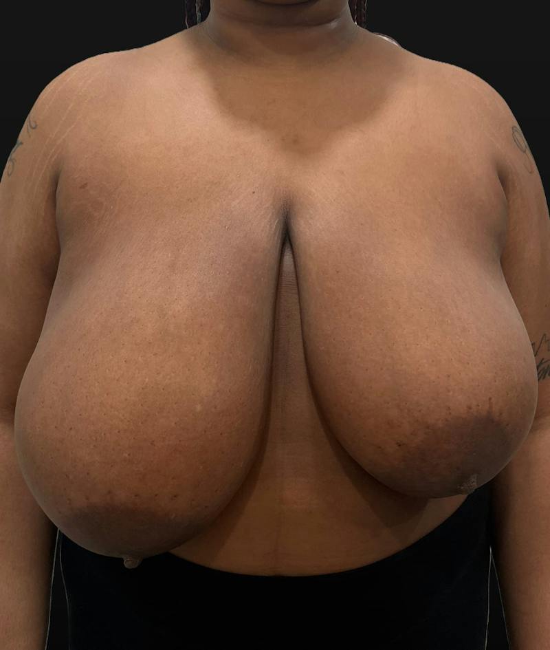 Breast Reduction Before & After Gallery - Patient 116976 - Image 1