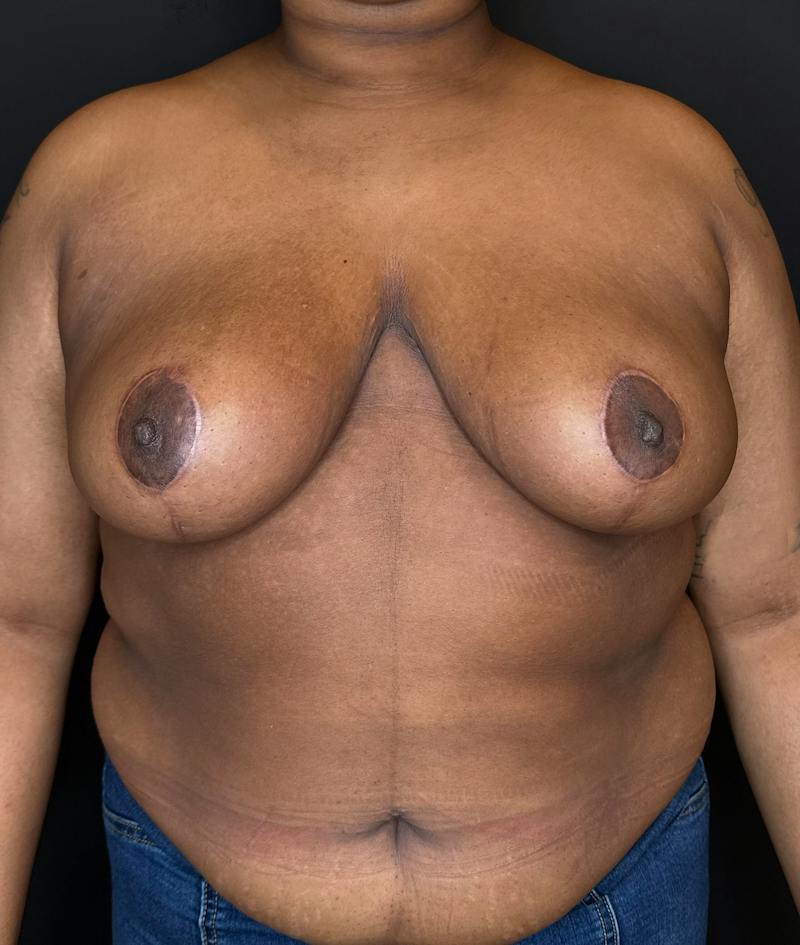 Breast Reduction Before & After Gallery - Patient 116976 - Image 2