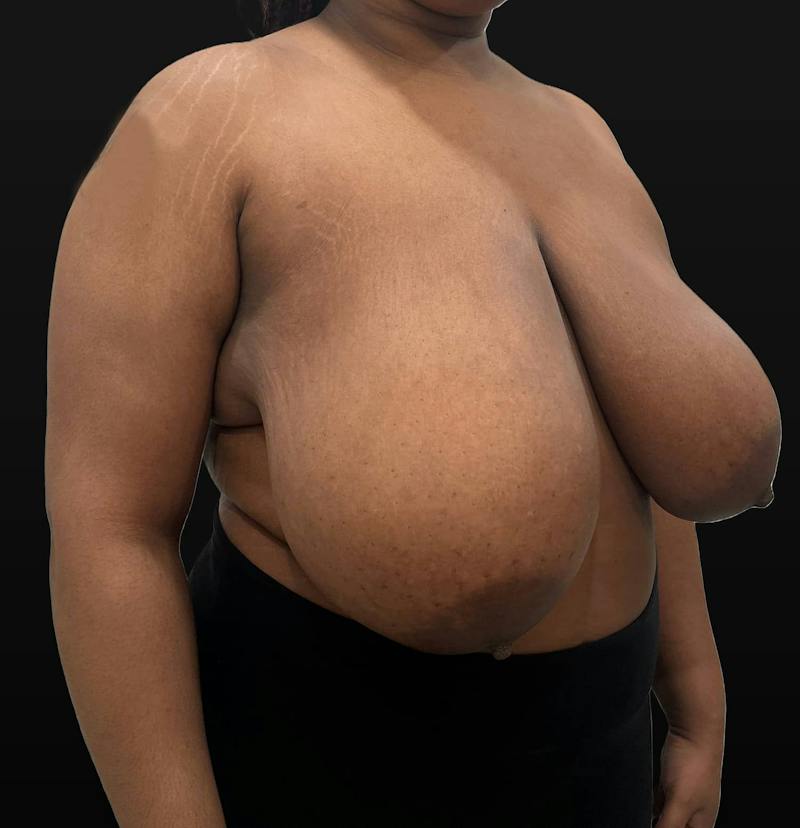 Breast Reduction Before & After Gallery - Patient 116976 - Image 3