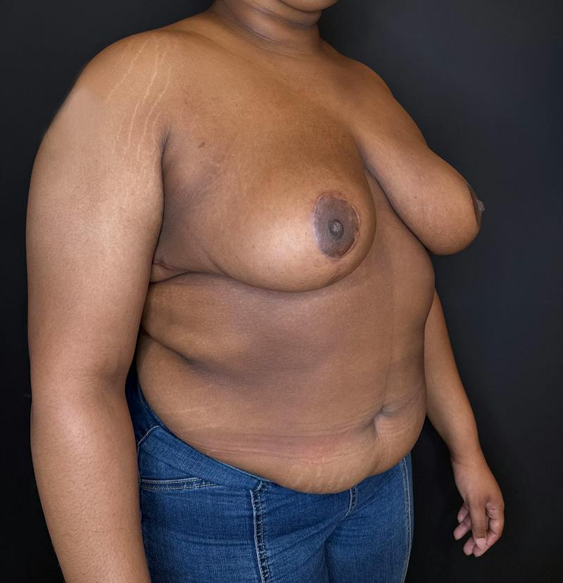 Breast Reduction Before & After Gallery - Patient 116976 - Image 4