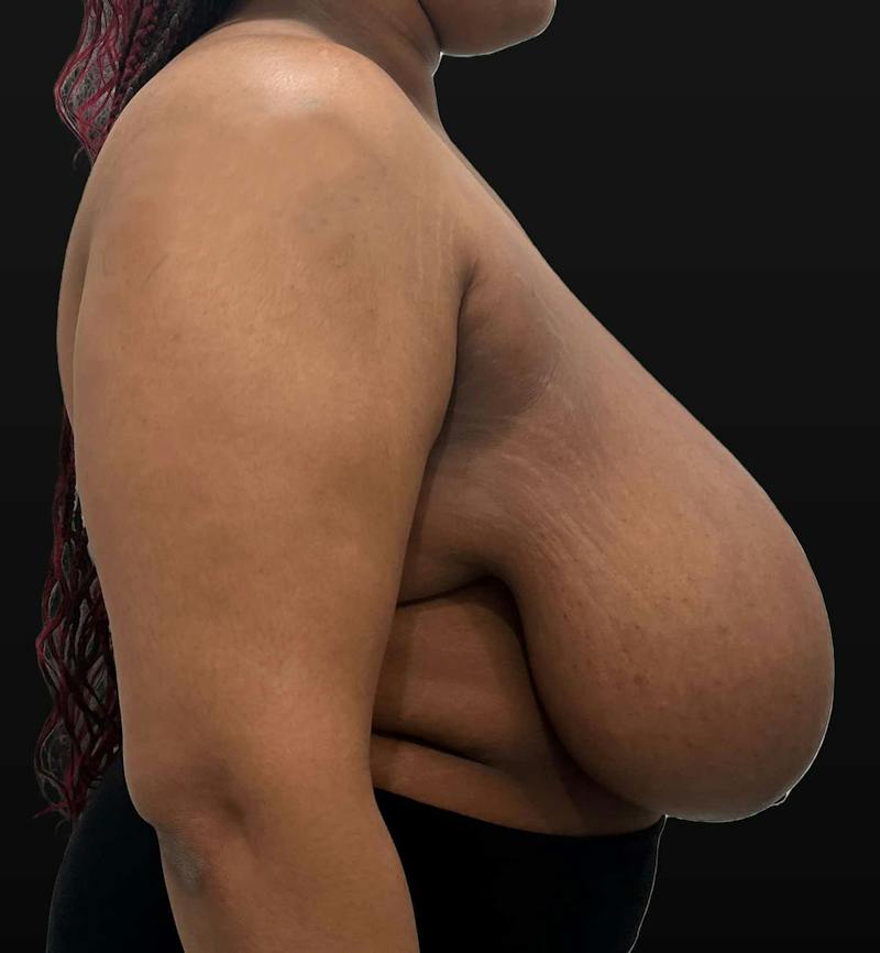 Breast Reduction Before & After Gallery - Patient 116976 - Image 5