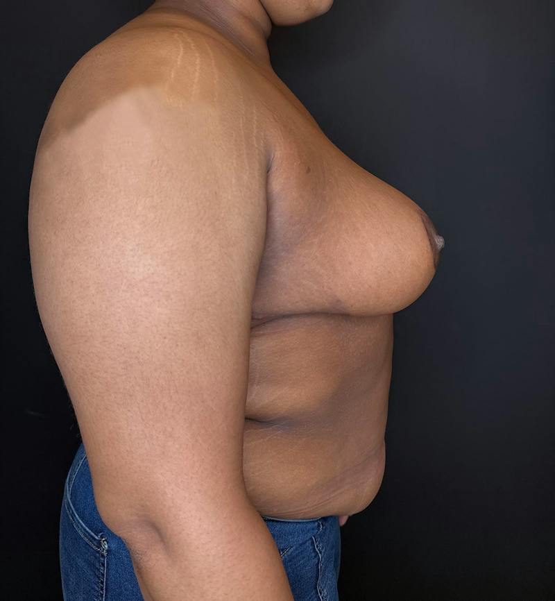 Breast Reduction Before & After Gallery - Patient 116976 - Image 6