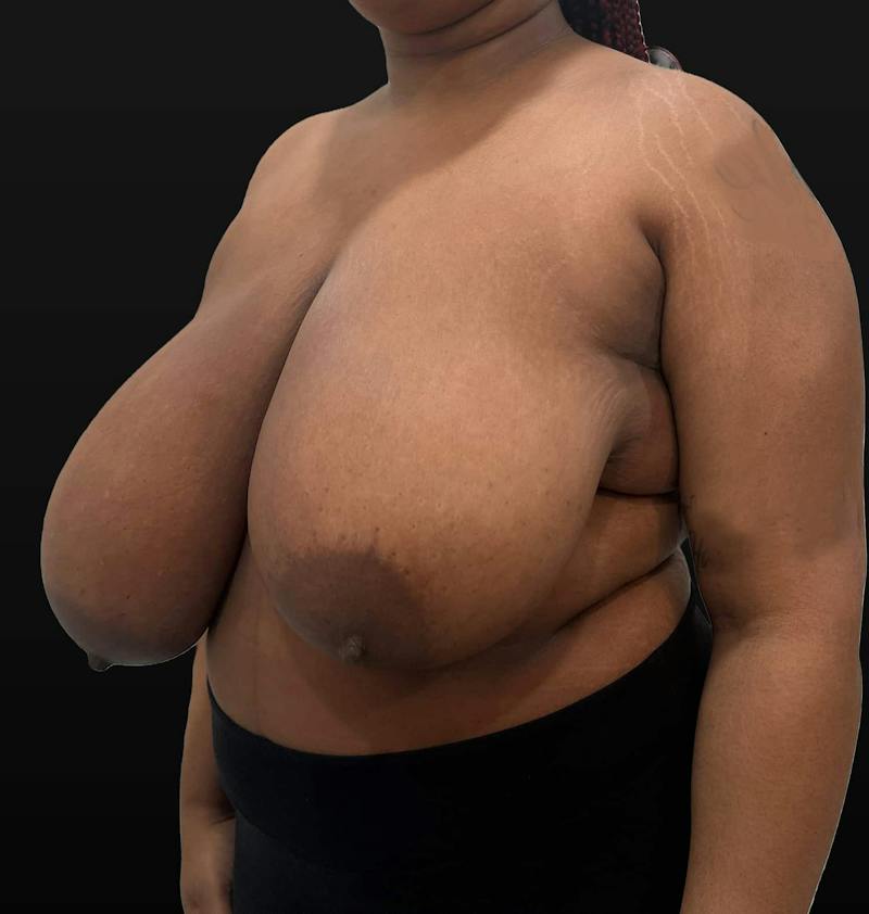 Breast Reduction Before & After Gallery - Patient 116976 - Image 7