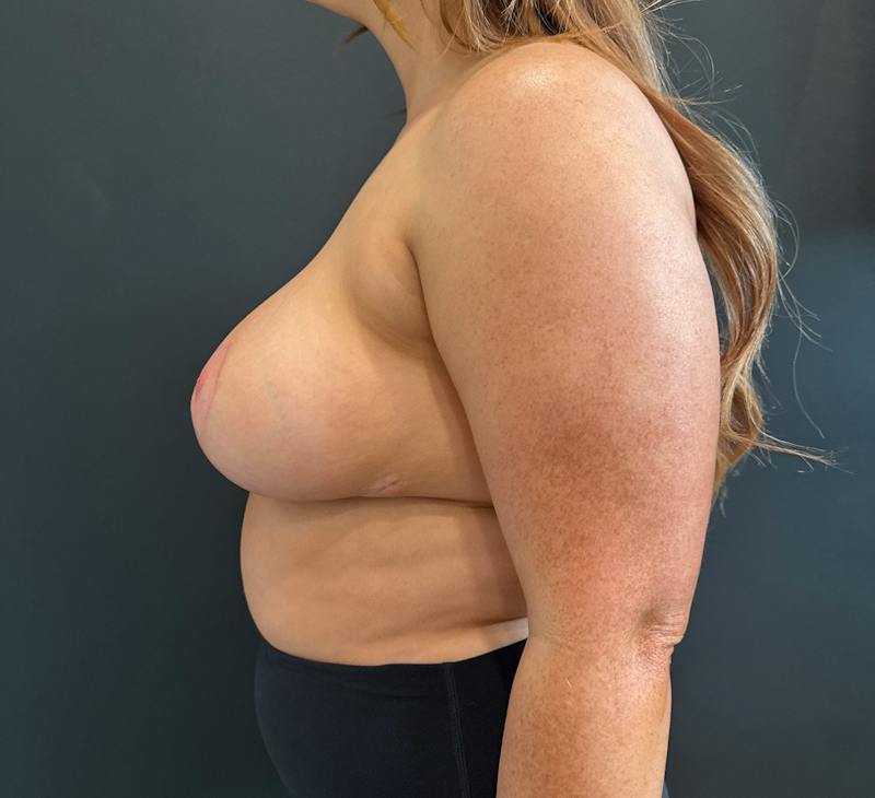 Breast Reduction Before & After Gallery - Patient 376821 - Image 4