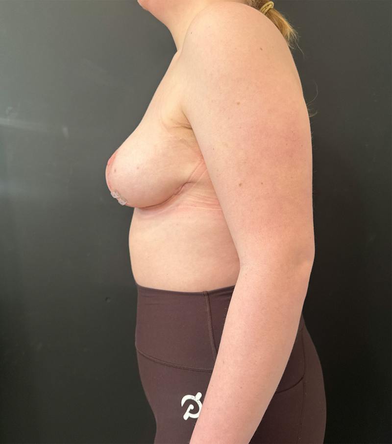 Breast Reduction Before & After Gallery - Patient 740304 - Image 4