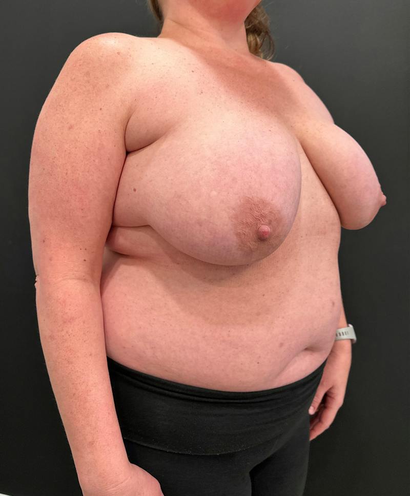 SAFElipo Before & After Gallery - Patient 166324 - Image 3