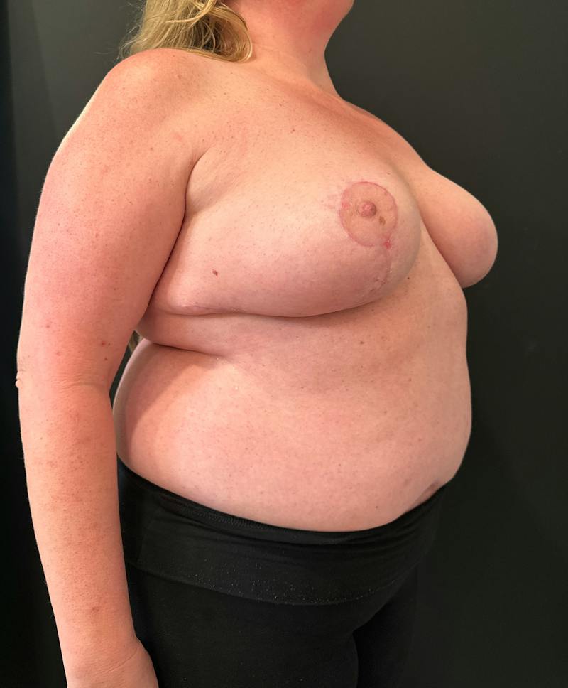 SAFElipo Before & After Gallery - Patient 166324 - Image 4