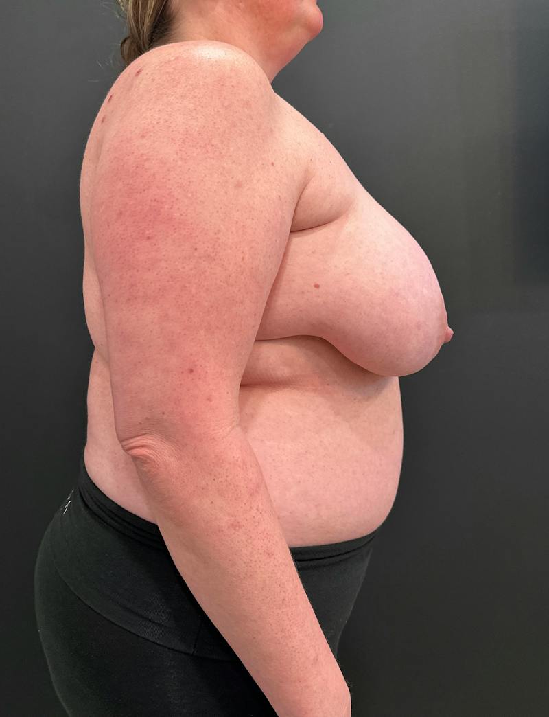 SAFElipo Before & After Gallery - Patient 166324 - Image 5