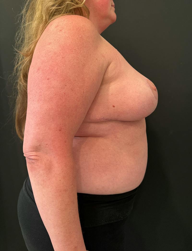 SAFElipo Before & After Gallery - Patient 166324 - Image 6