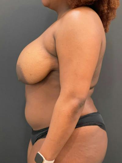 Breast Reduction Before & After Gallery - Patient 101182 - Image 1