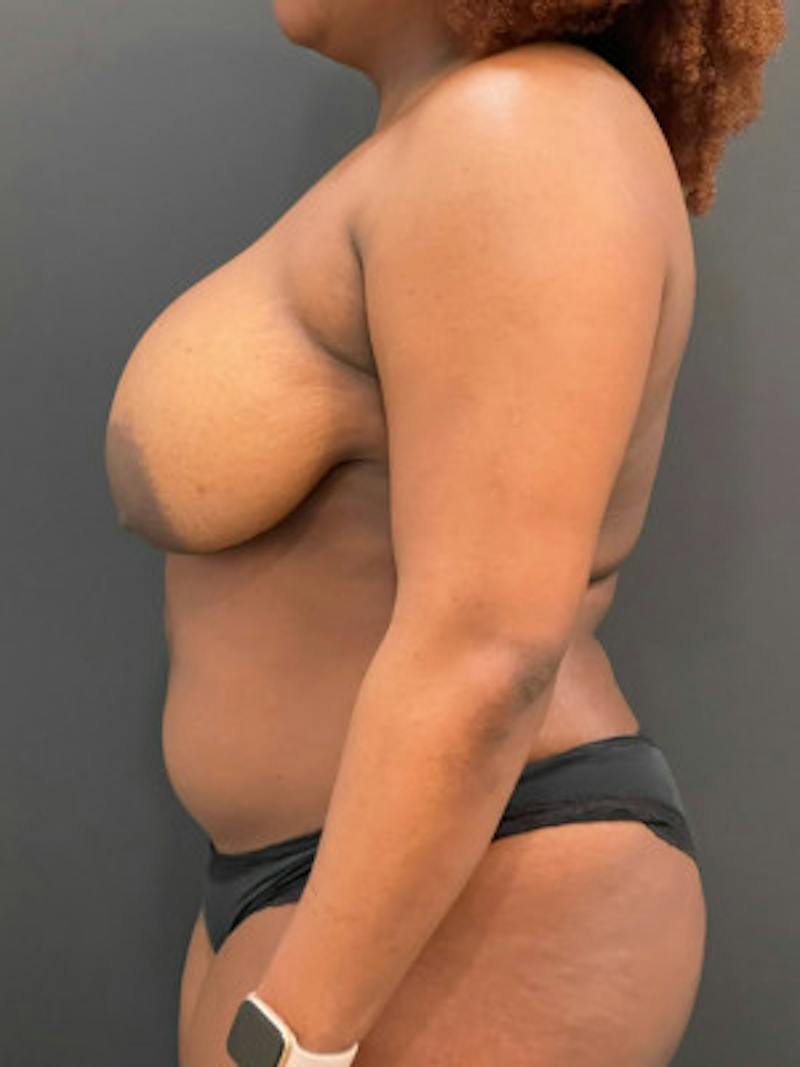 Breast Reduction Before & After Gallery - Patient 101182 - Image 1