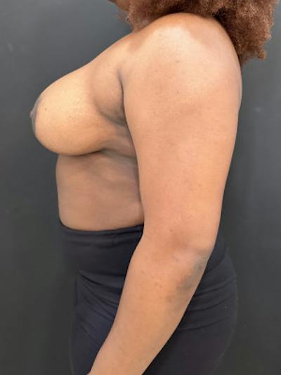 Breast Reduction Before & After Gallery - Patient 101182 - Image 2