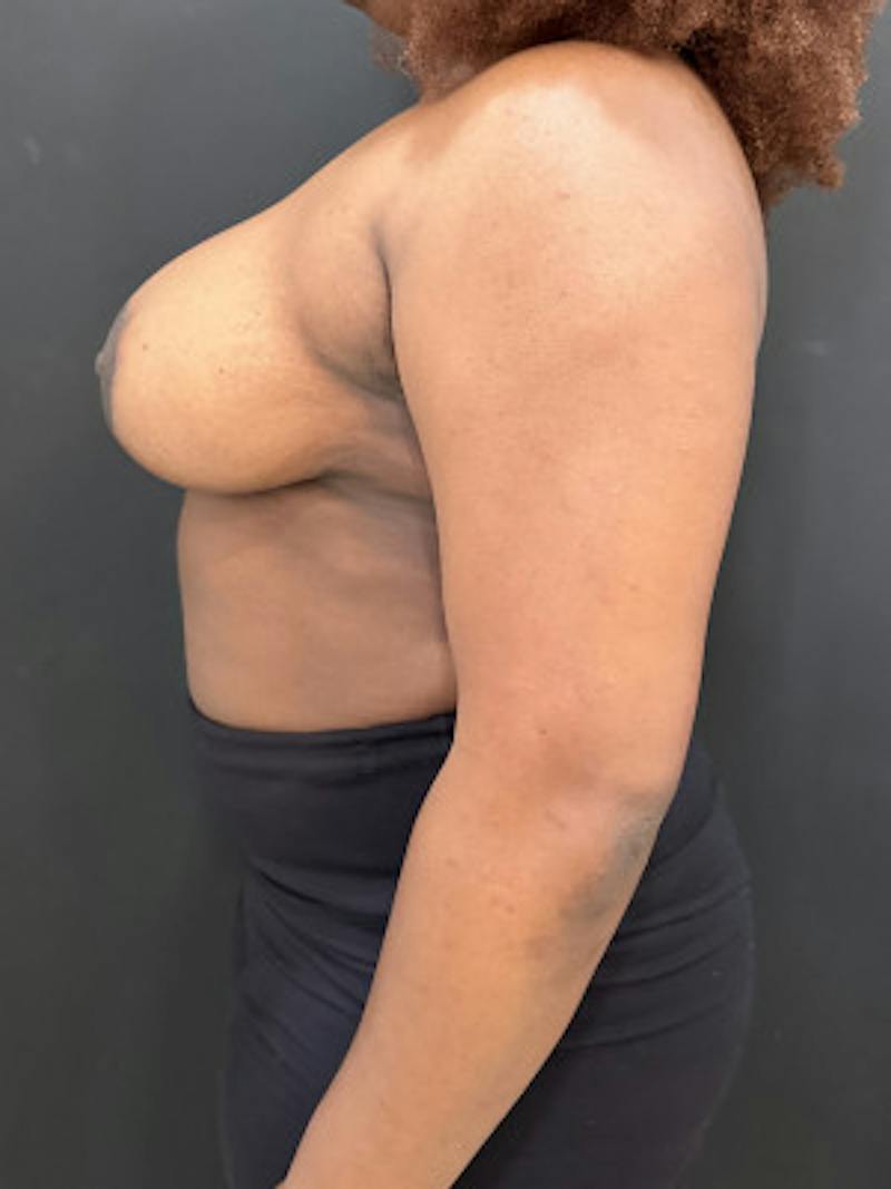 Breast Reduction Before & After Gallery - Patient 101182 - Image 2