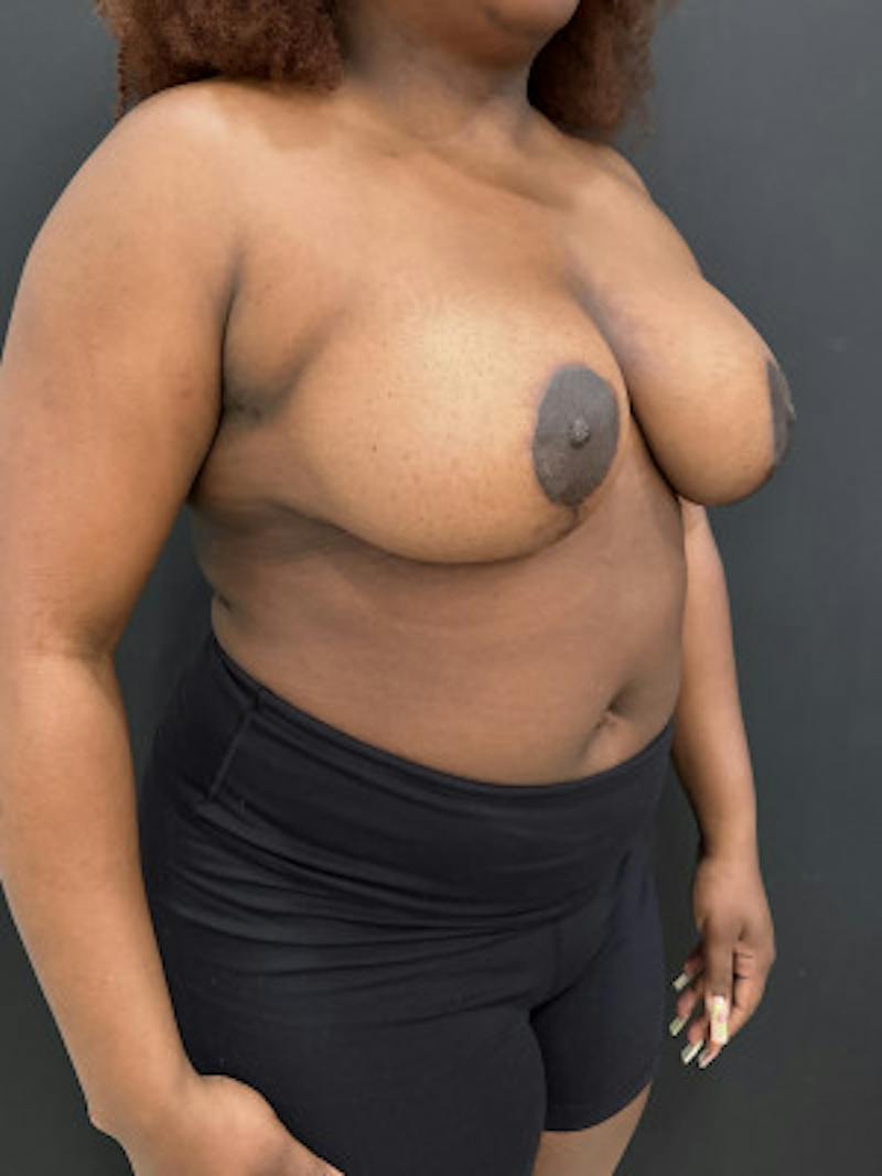 Breast Reduction Before & After Gallery - Patient 101182 - Image 4