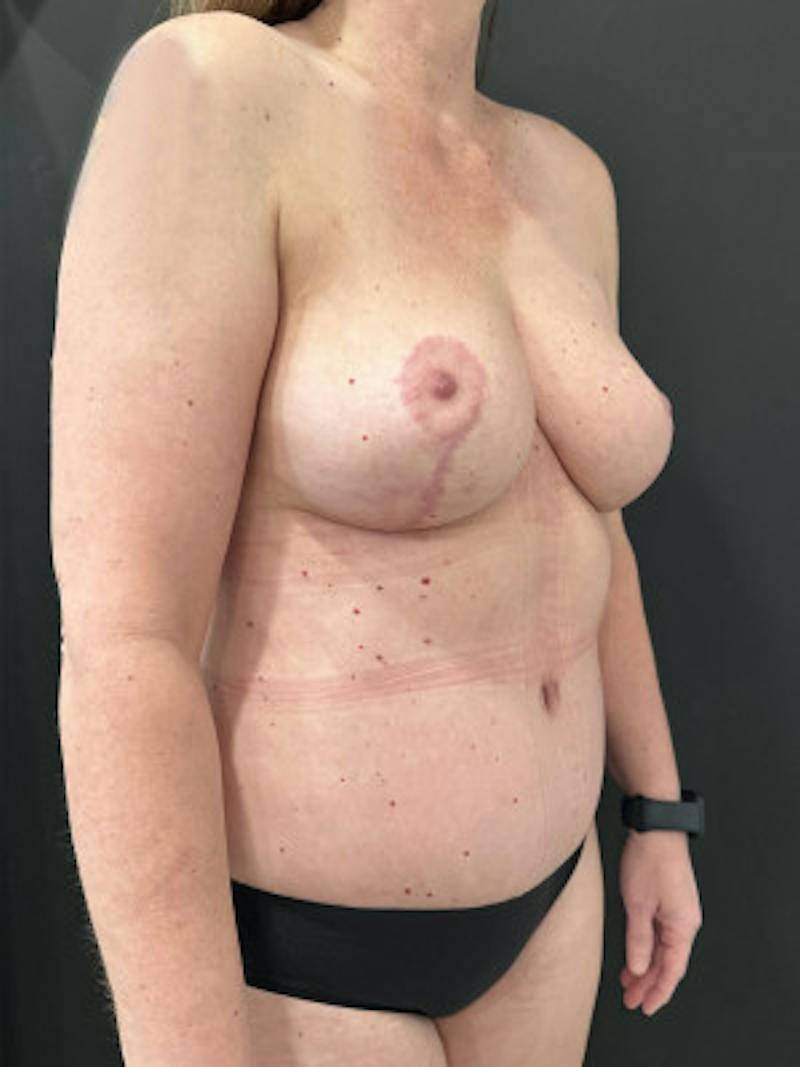 Mommy Makeover Before & After Gallery - Patient 214151 - Image 4