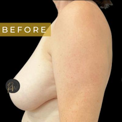 SAFElipo Before & After Gallery - Patient 208194 - Image 1