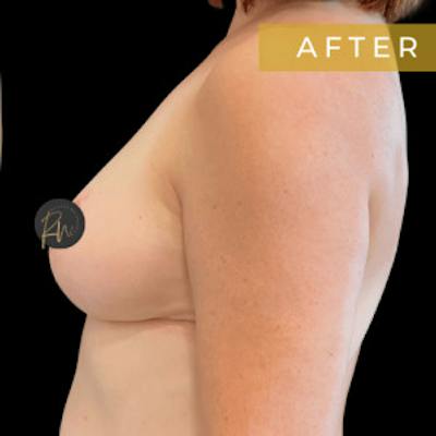 SAFElipo Before & After Gallery - Patient 208194 - Image 2
