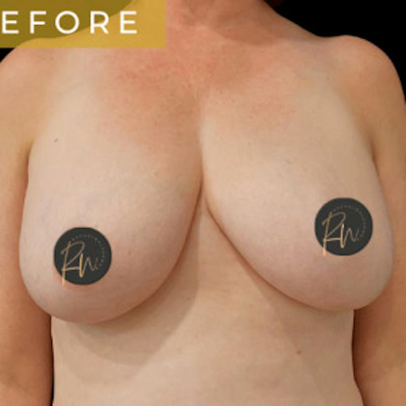 SAFElipo Before & After Gallery - Patient 208194 - Image 3