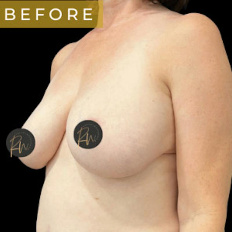 SAFElipo Before & After Gallery - Patient 208194 - Image 5