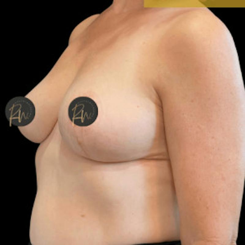 SAFElipo Before & After Gallery - Patient 208194 - Image 6