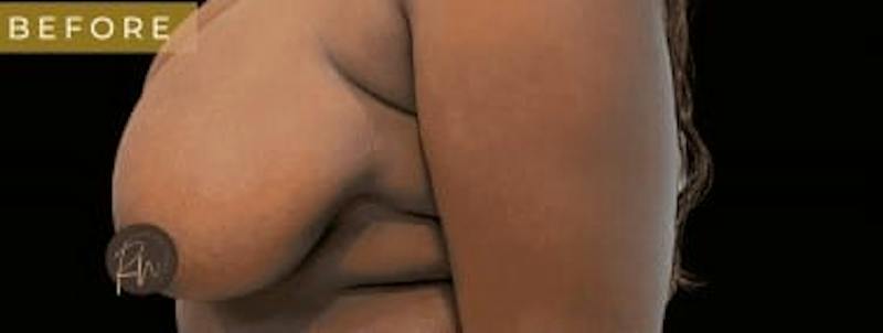 SAFElipo Before & After Gallery - Patient 248567 - Image 3