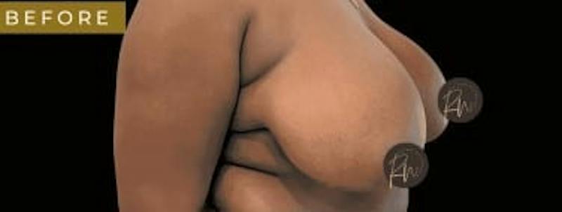 SAFElipo Before & After Gallery - Patient 248567 - Image 5
