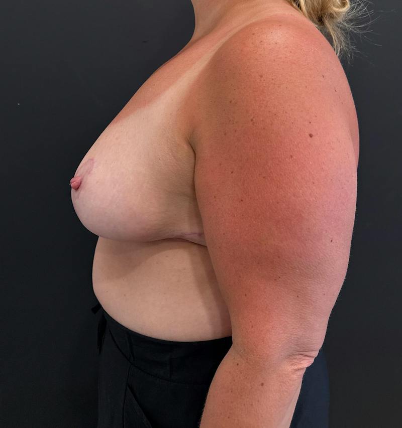 Breast Reduction Before & After Gallery - Patient 333378 - Image 4