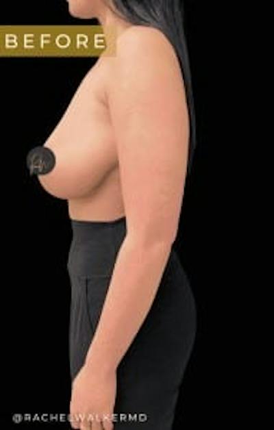 Breast Reduction Before & After Gallery - Patient 150696 - Image 1