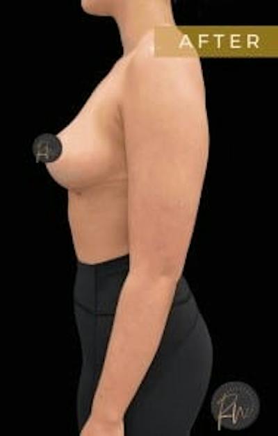 Breast Reduction Before & After Gallery - Patient 150696 - Image 2