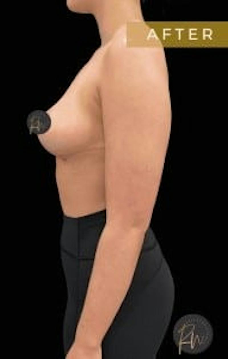 Breast Reduction Before & After Gallery - Patient 150696 - Image 2
