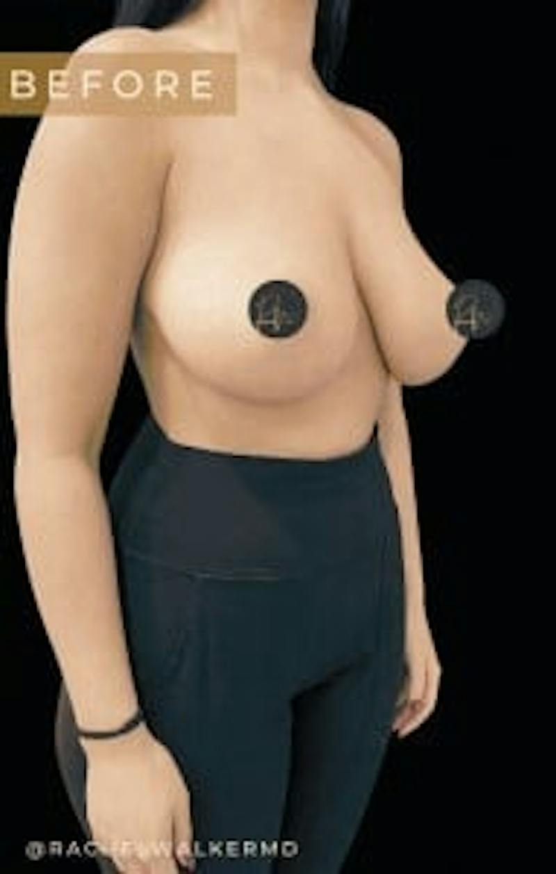 Breast Reduction Before & After Gallery - Patient 150696 - Image 3