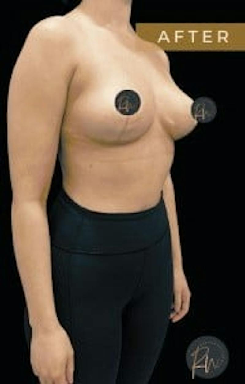 Breast Reduction Before & After Gallery - Patient 150696 - Image 4