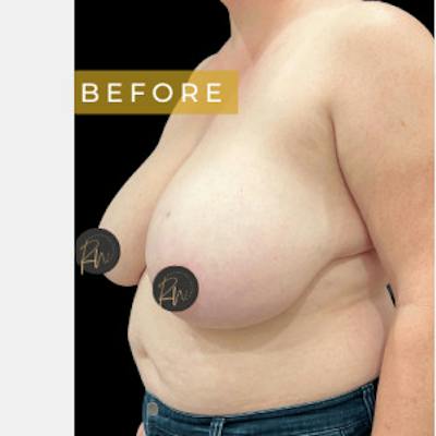SAFElipo Before & After Gallery - Patient 310552 - Image 1