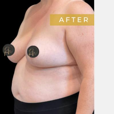 SAFElipo Before & After Gallery - Patient 310552 - Image 2
