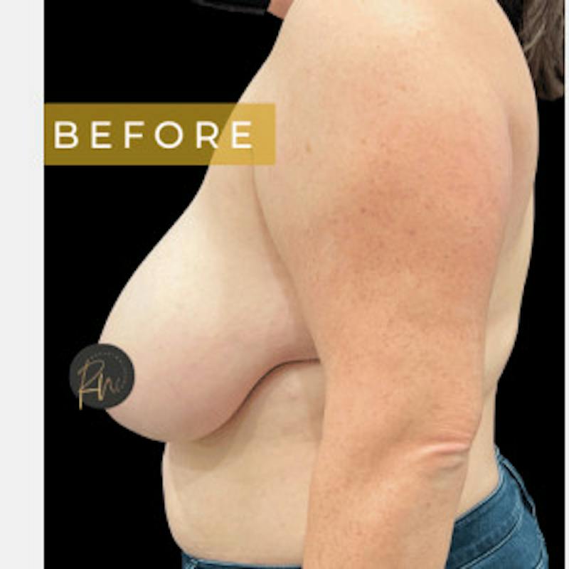 SAFElipo Before & After Gallery - Patient 310552 - Image 3