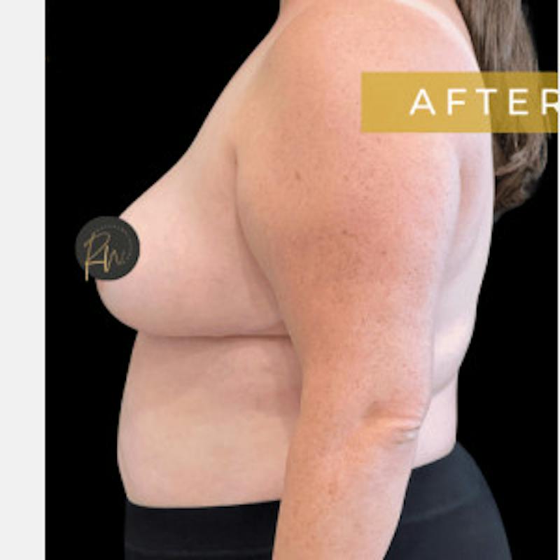 SAFElipo Before & After Gallery - Patient 310552 - Image 4