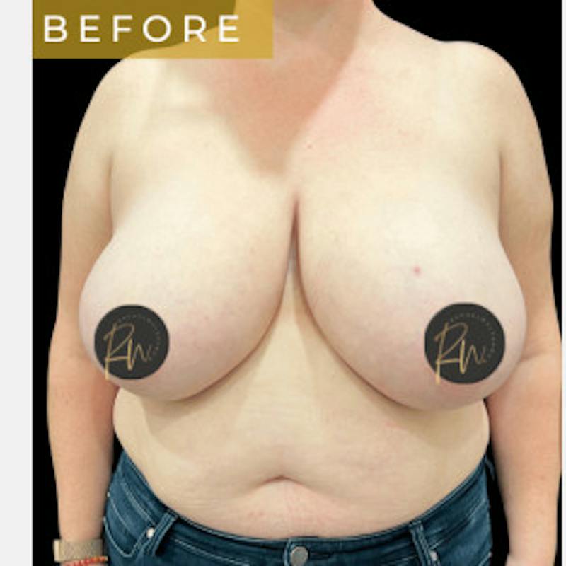 SAFElipo Before & After Gallery - Patient 310552 - Image 5
