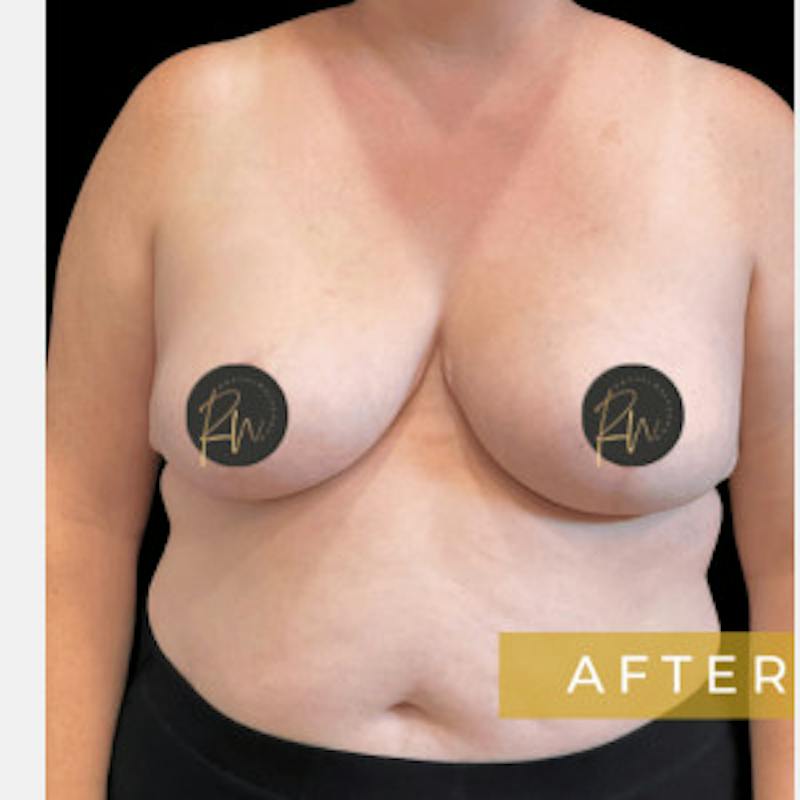 SAFElipo Before & After Gallery - Patient 310552 - Image 6