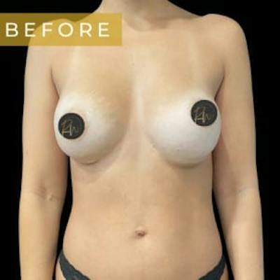 Breast Revision/Correction Before & After Gallery - Patient 706229 - Image 1