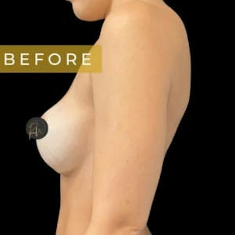 Breast Revision/Correction Before & After Gallery - Patient 706229 - Image 3