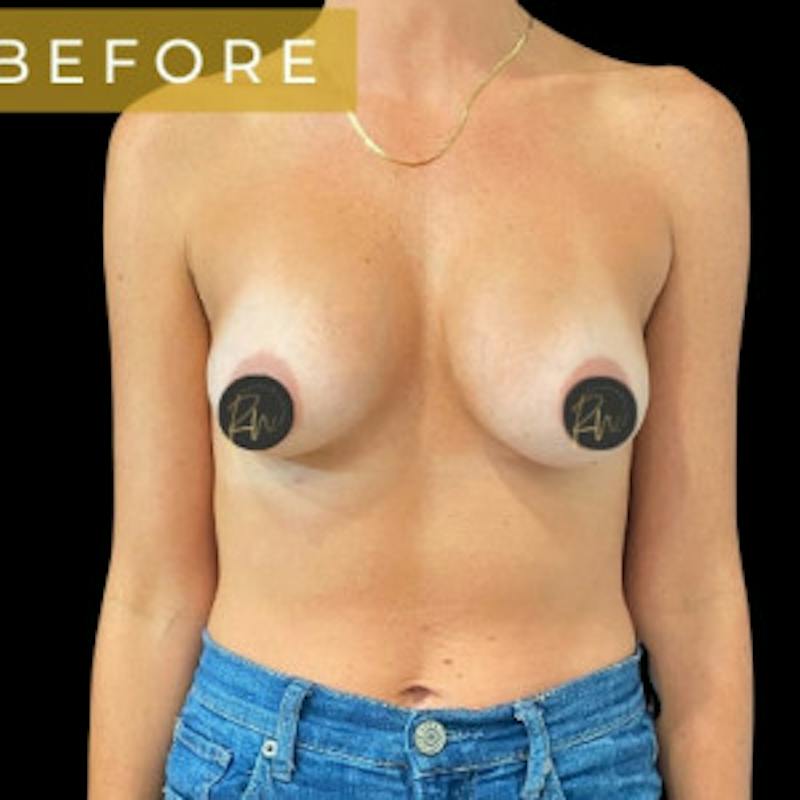 Breast Revision/Correction Before & After Gallery - Patient 423782 - Image 1