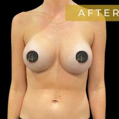 Breast Revision/Correction Before & After Gallery - Patient 423782 - Image 2