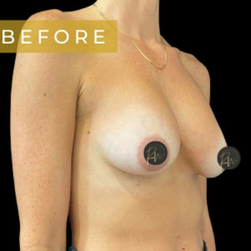 Breast Revision/Correction Before & After Gallery - Patient 423782 - Image 3