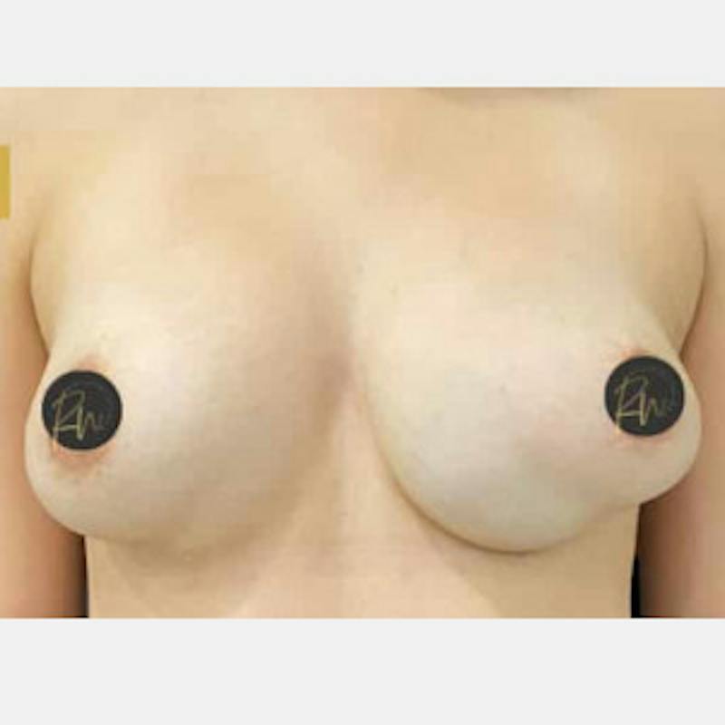 Breast Revision/Correction Before & After Gallery - Patient 317932 - Image 1