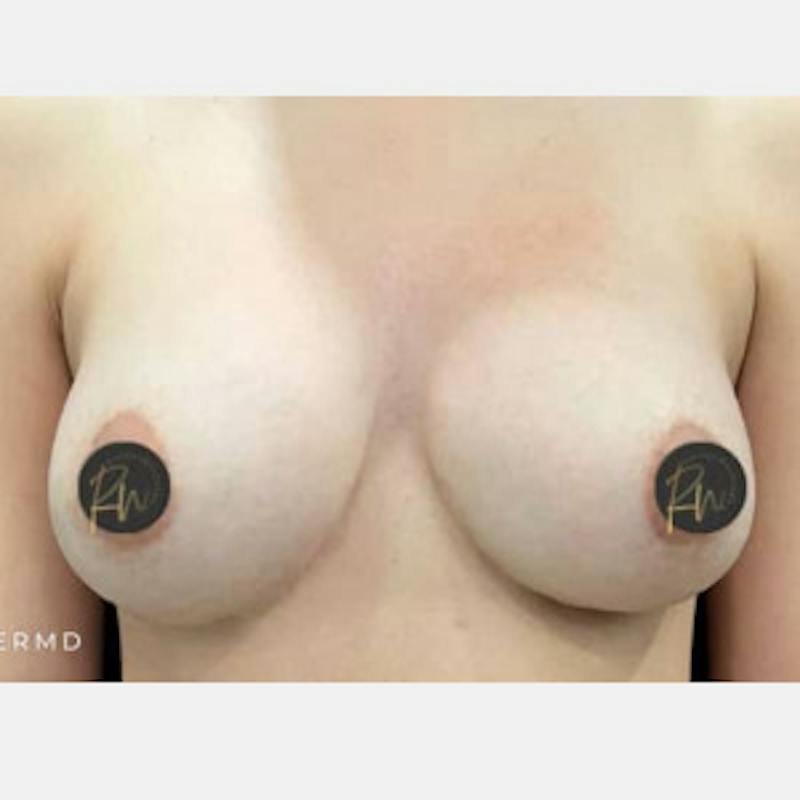Breast Revision/Correction Before & After Gallery - Patient 317932 - Image 2