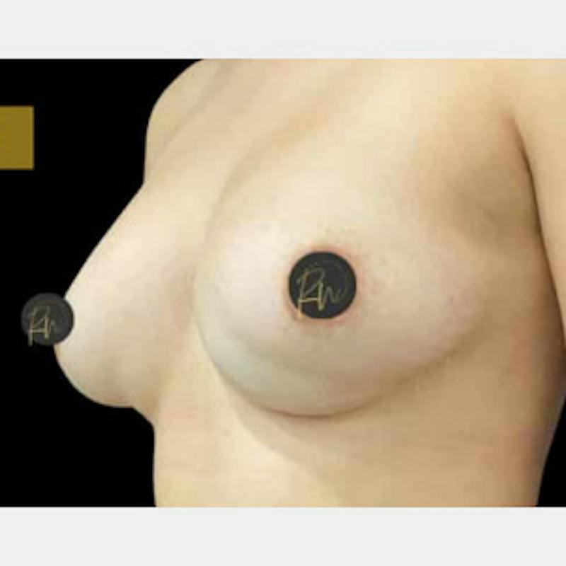 Breast Revision/Correction Before & After Gallery - Patient 317932 - Image 3