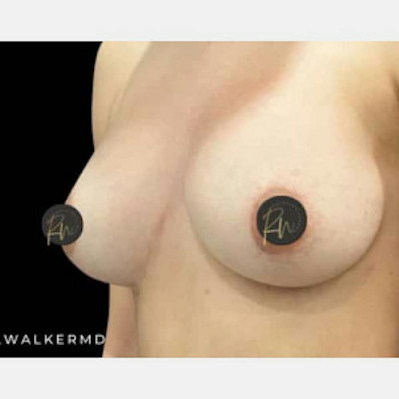 Breast Revision/Correction Before & After Gallery - Patient 317932 - Image 4