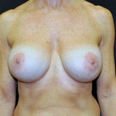 Breast Revision/Correction Before & After Gallery - Patient 270004 - Image 2